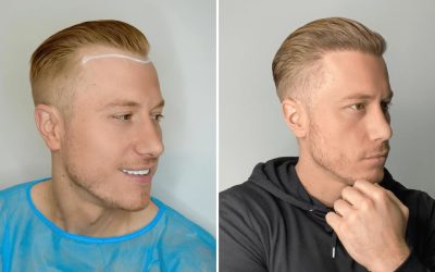 Hair Transplant Cape Town