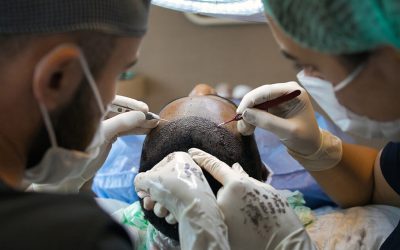 Afro Type Hair Transplant