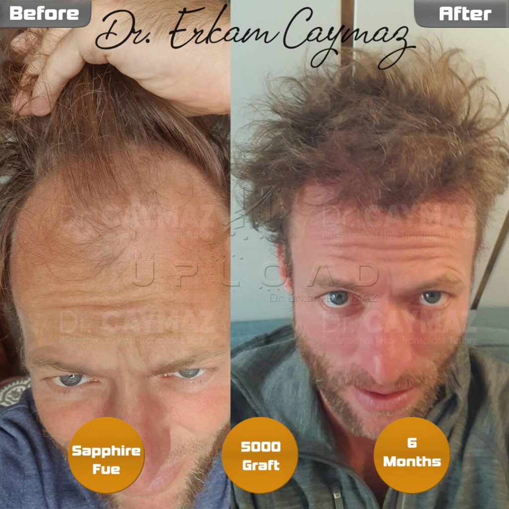 Am I A Suitable Candidate For A Hair Transplant?