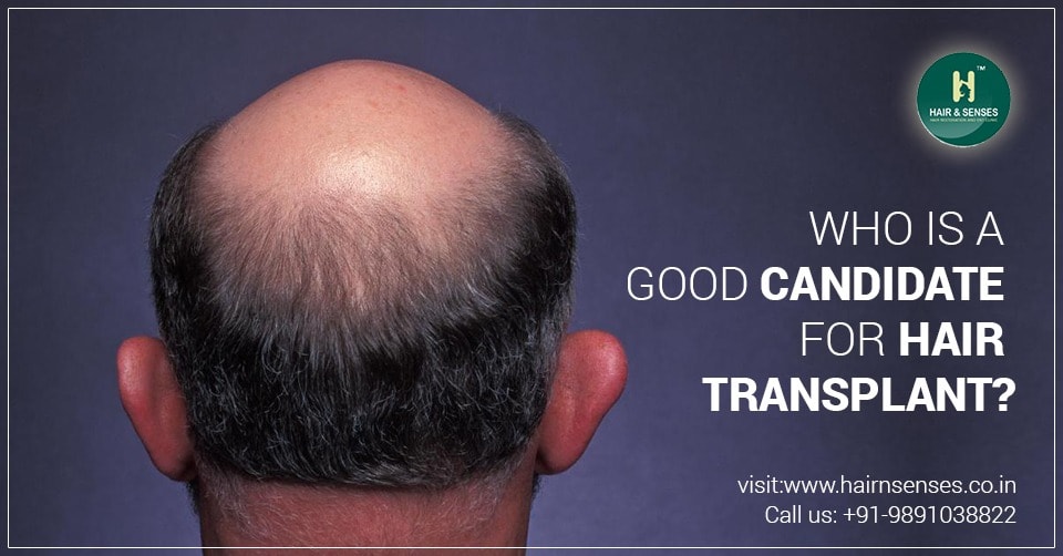 Am I A Suitable Candidate For A Hair Transplant?