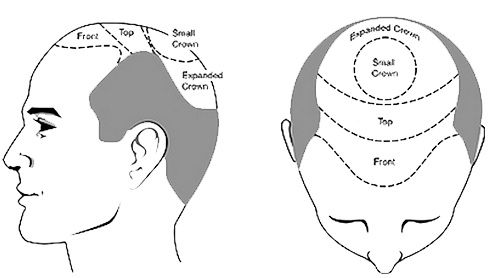 Am I A Suitable Candidate For A Hair Transplant?