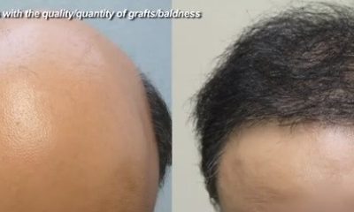 Am I A Suitable Candidate For A Hair Transplant?