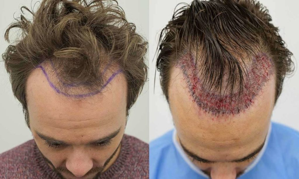 Are Hair Transplants Permanent?