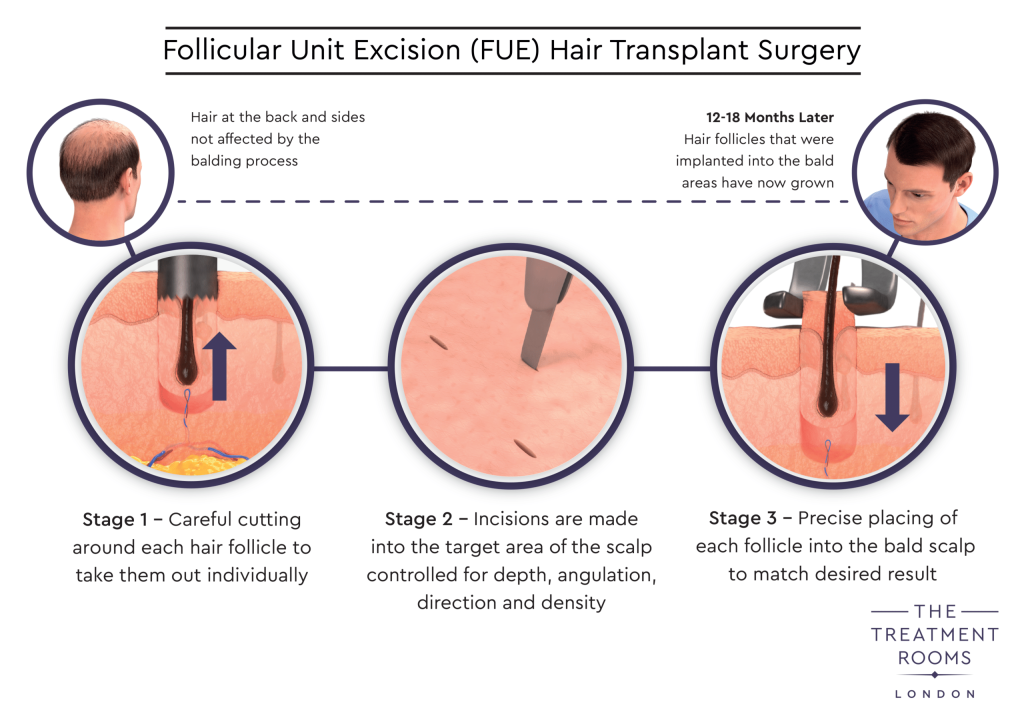 Are Hair Transplants Permanent?