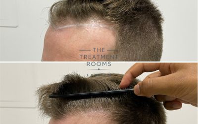 Are Hair Transplants Permanent?