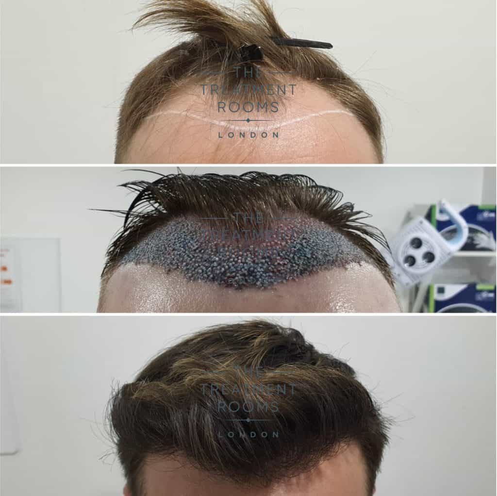 Hair Transplant