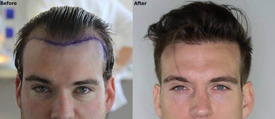 Hair Transplant Johannesburg