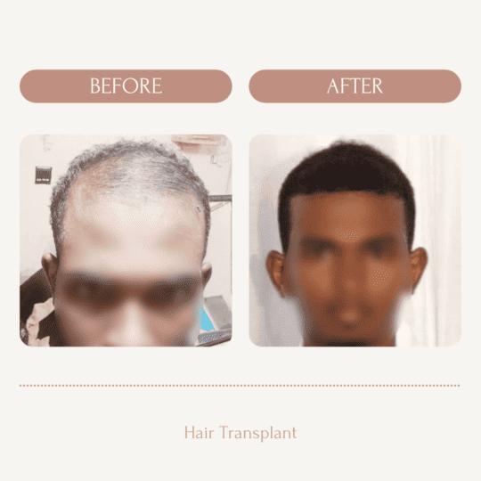 Hair Transplant Johannesburg