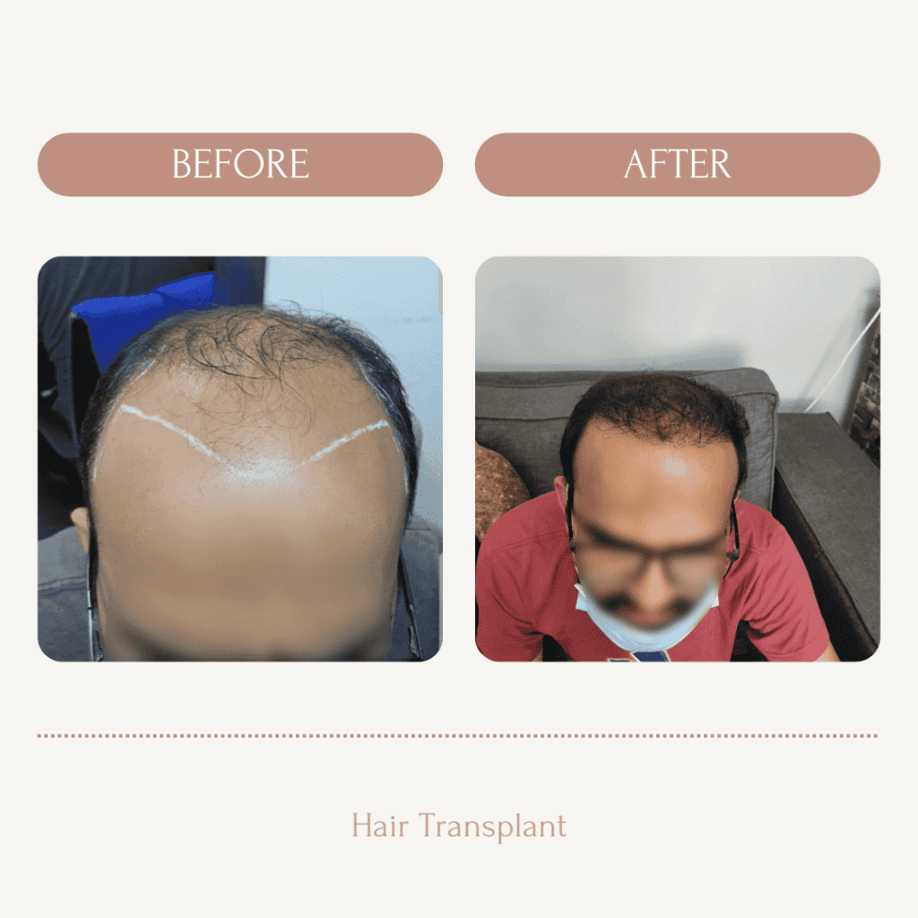 Hair Transplant Johannesburg