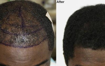 Hair Transplant Johannesburg