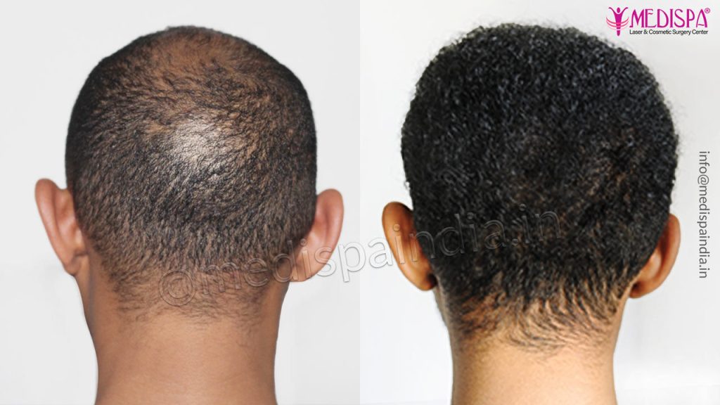 Hair Transplant South Africa