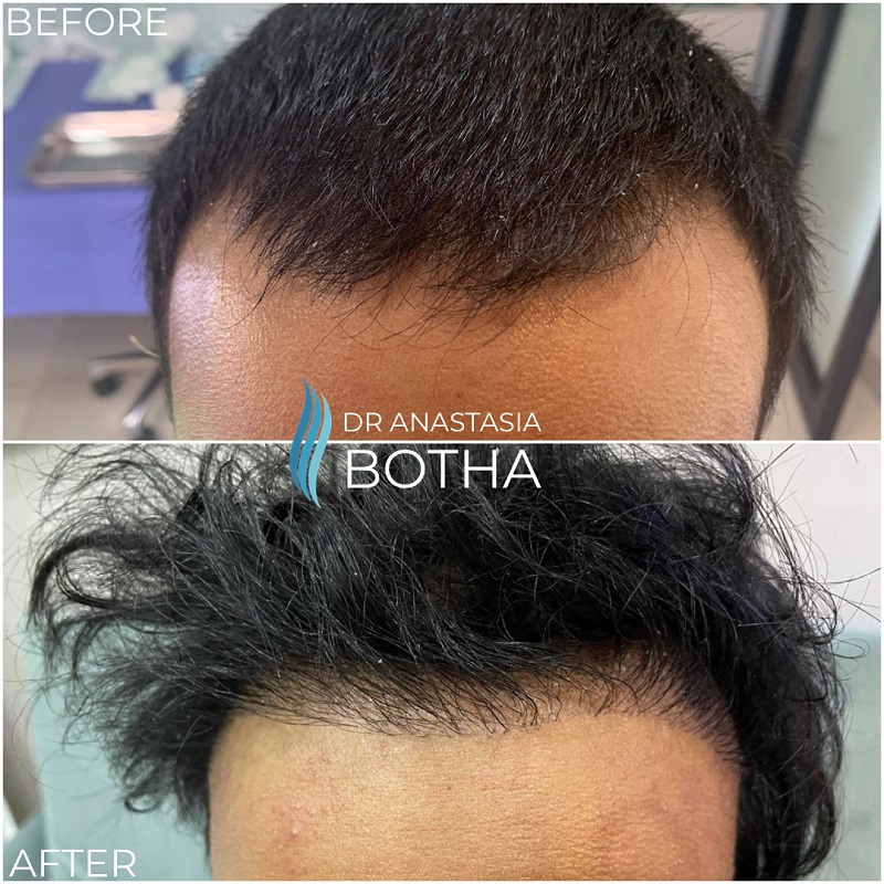 Hair Transplant South Africa