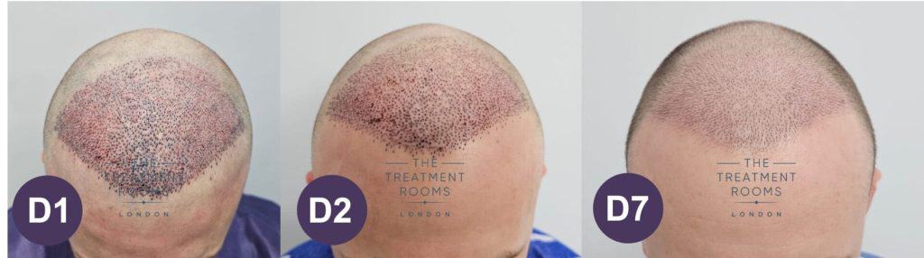 How Soon Can I Wash My Hair After The Hair Transplant Surgery?