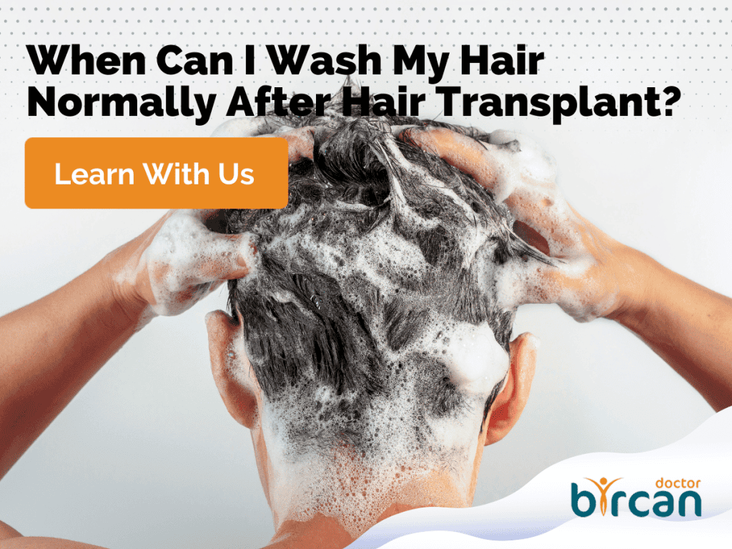 How Soon Can I Wash My Hair After The Hair Transplant Surgery?