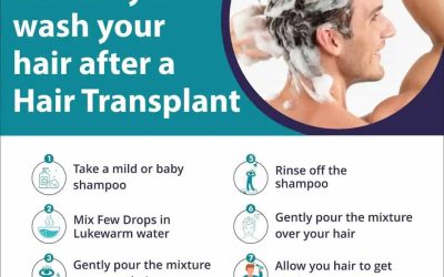 How Soon Can I Wash My Hair After The Hair Transplant Surgery?