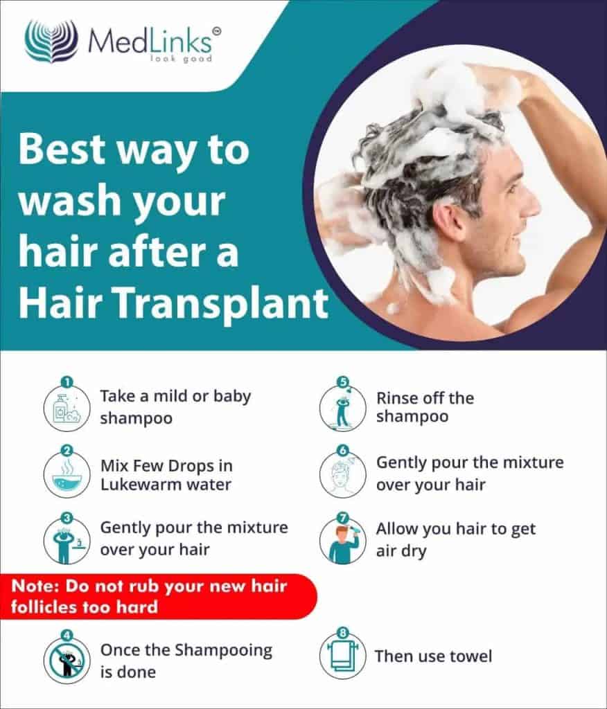 How Soon Can I Wash My Hair After The Hair Transplant Surgery?