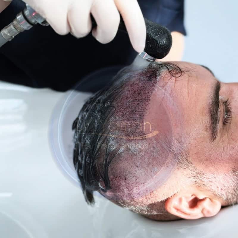 How Soon Can I Wash My Hair After The Hair Transplant Surgery?