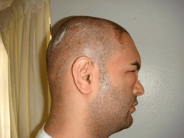 Is It Normal To Experience Swelling In The Scalp After The Procedure?