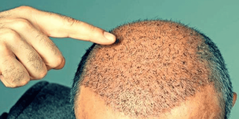 Is It Normal To Experience Swelling In The Scalp After The Procedure?