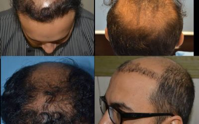 What Are The Risks And Side Effects Associated With Hair Transplants?