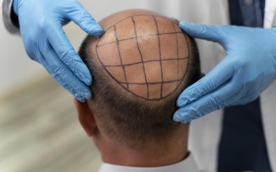 When Can I Return To Work Or Resume Normal Activities After A Hair Transplant?