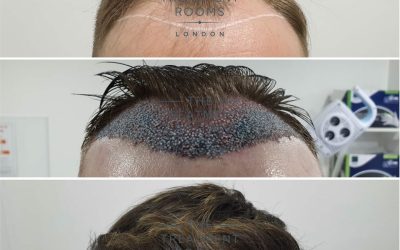 Women Hair Transplant