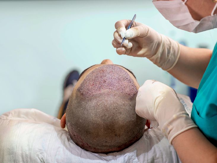 How Long Does A Hair Transplant Procedure Take?