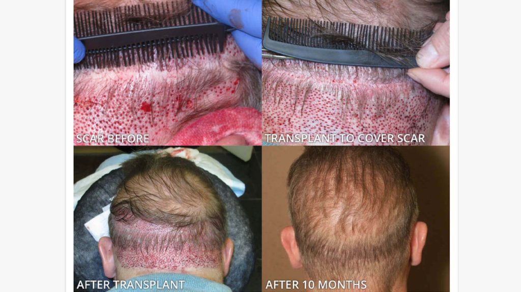 How Long Does A Hair Transplant Procedure Take?