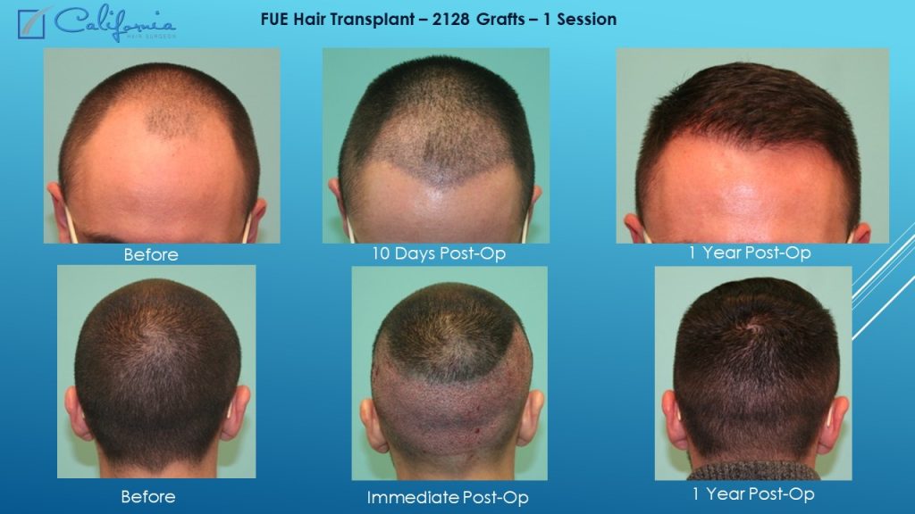 How Long Does A Hair Transplant Procedure Take?