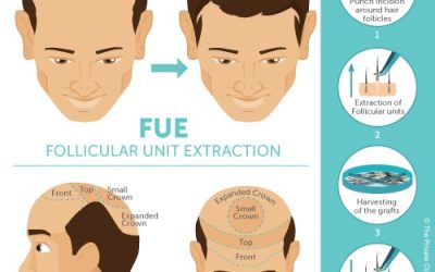 How Long Does A Hair Transplant Procedure Take?