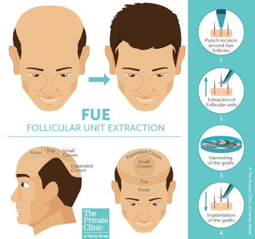 How Long Does A Hair Transplant Procedure Take?