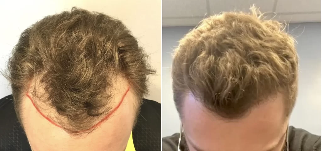 When Will I See The Results Of My Hair Transplant?