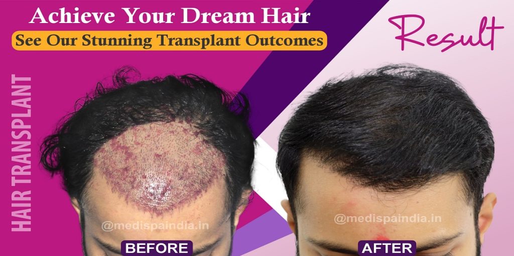 When Will I See The Results Of My Hair Transplant?