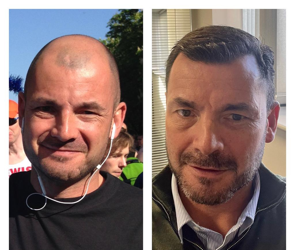 Will A Hair Transplant Look Natural?