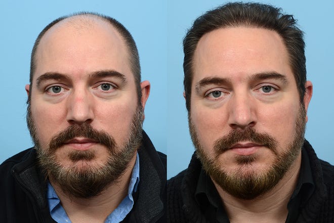 Will A Hair Transplant Look Natural?