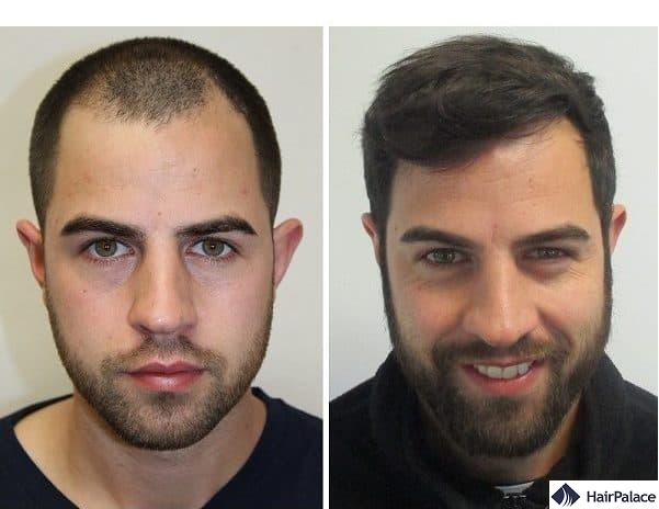 Will A Hair Transplant Look Natural?