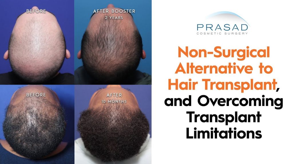 Are There Alternatives To Hair Transplants For Hair Restoration?