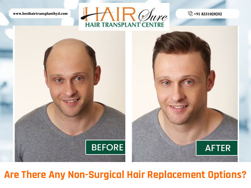 Are There Alternatives To Hair Transplants For Hair Restoration?