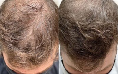 Are There Alternatives To Hair Transplants For Hair Restoration?