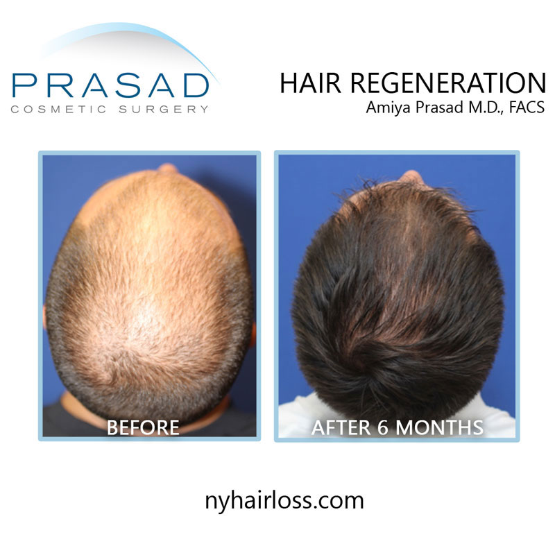 Are There Alternatives To Hair Transplants For Hair Restoration?