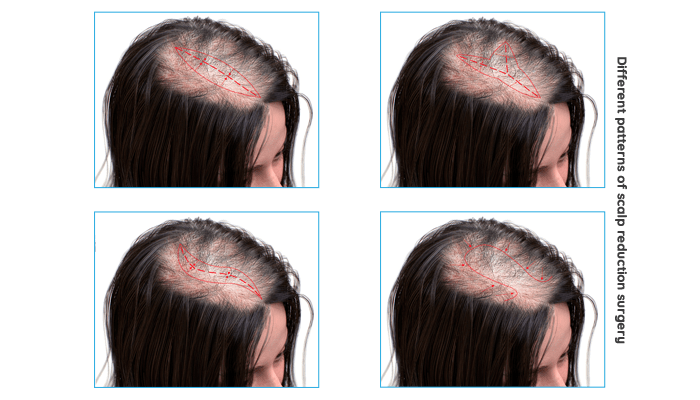 Are There Any Specific Instructions For Caring For My Scalp Leading Up To The Surgery?