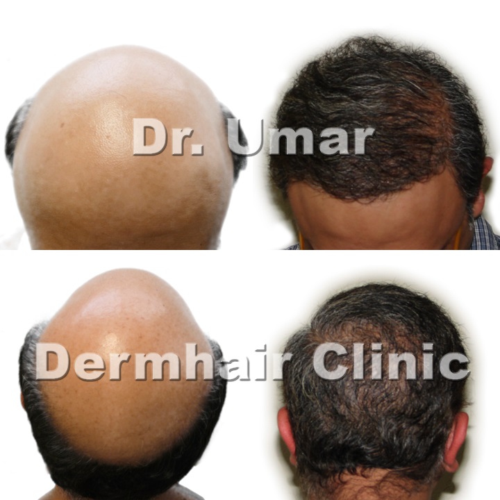 Can A Hair Transplant Be Performed On Other Parts Of The Body Besides The Scalp?