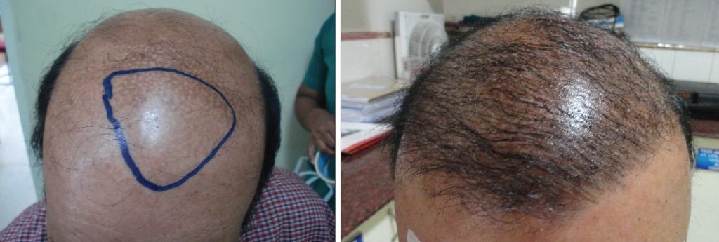 Can A Hair Transplant Be Performed On Other Parts Of The Body Besides The Scalp?