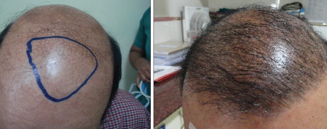 Can A Hair Transplant Be Performed On Other Parts Of The Body Besides The Scalp?