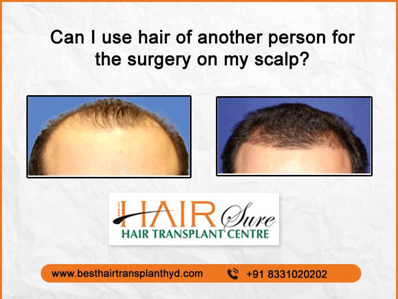 Can A Hair Transplant Be Performed On Other Parts Of The Body Besides The Scalp?