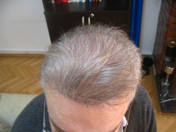 Can A Hair Transplant Be Performed On Other Parts Of The Body Besides The Scalp?