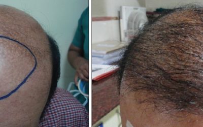 Can A Hair Transplant Be Performed On Other Parts Of The Body Besides The Scalp?