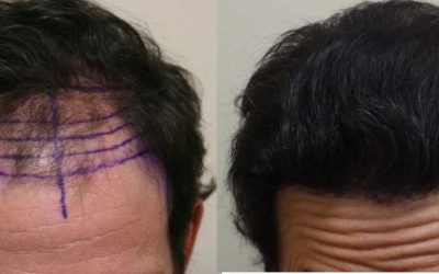 Can I Still Dye Or Style My Hair After A Transplant?