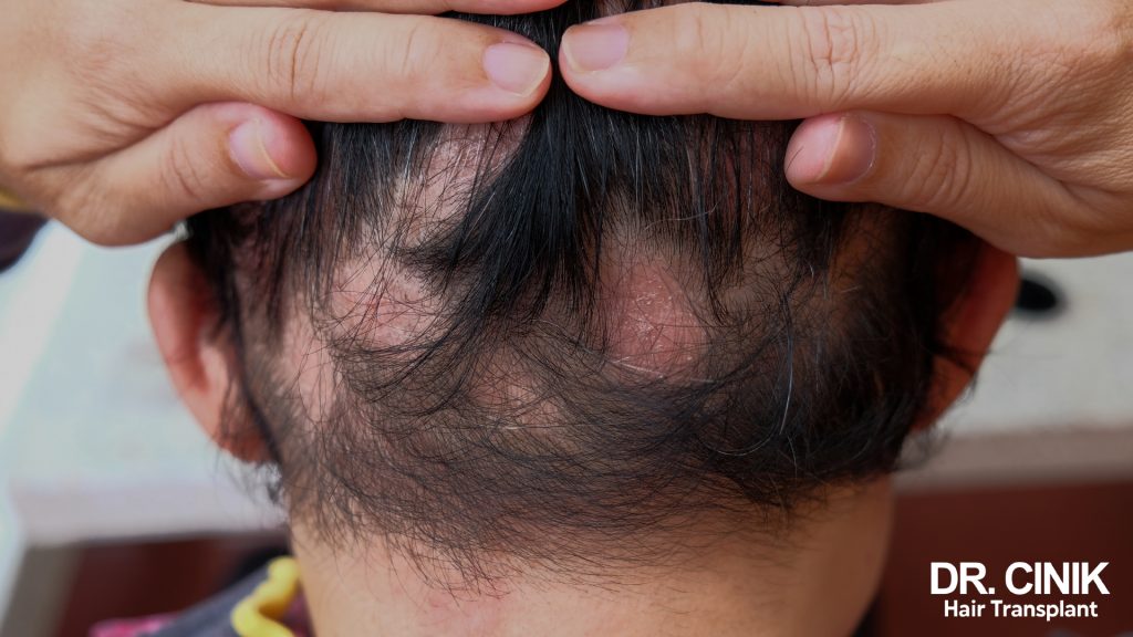 Can I Undergo A Hair Transplant If I Have A Medical Condition Or Am On Medication?