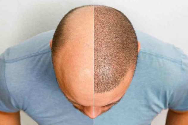 How Long Should I Avoid Direct Sunlight Exposure On My Scalp?